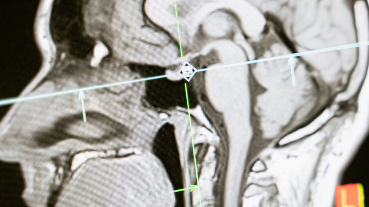 Chorea Huntington – neurologische Erbkrankheit und Verlauf