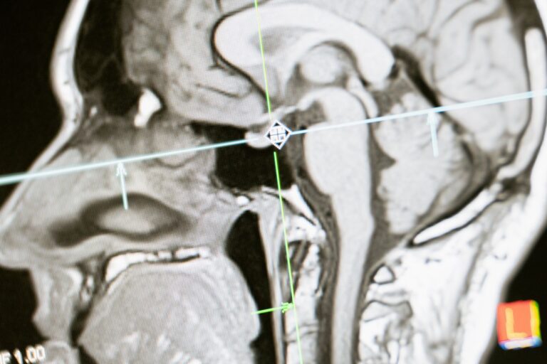 Chorea Huntington – neurologische Erbkrankheit und Verlauf