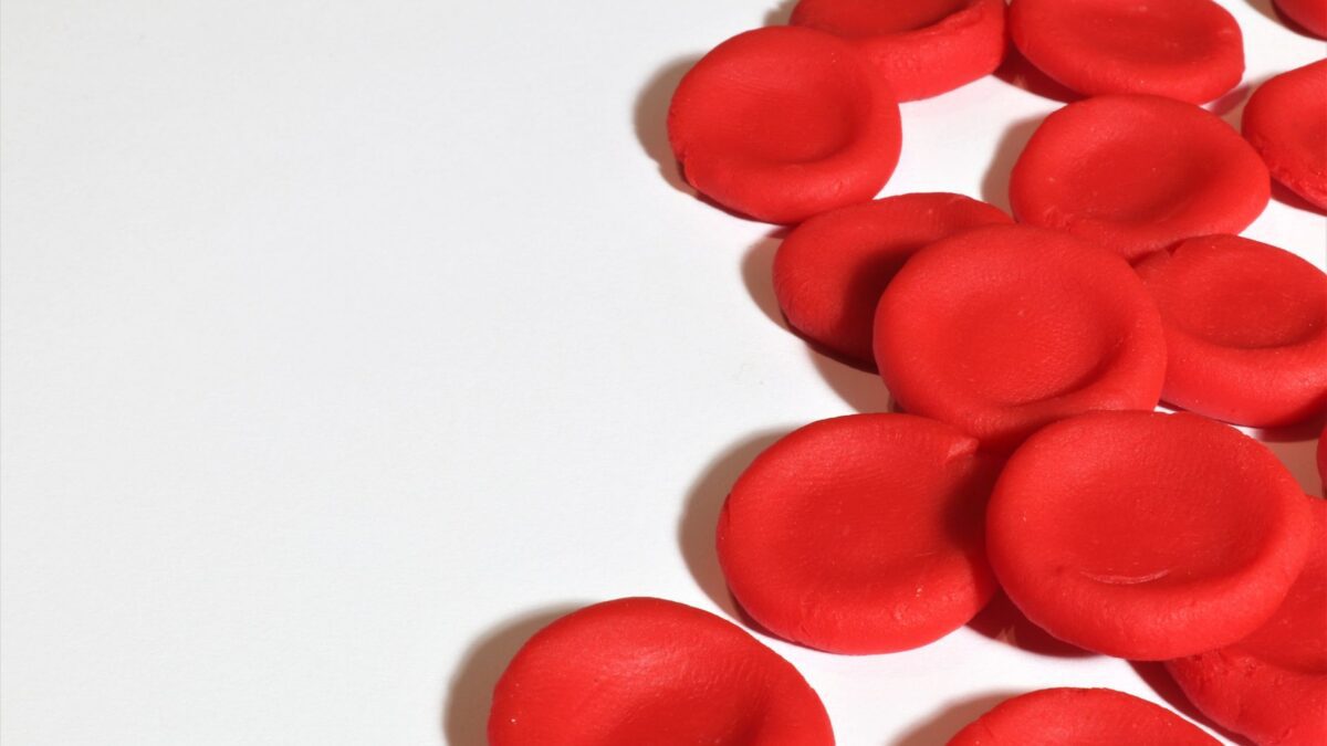 Sichelzellanämie – verformte rote Blutkörperchen und Hämoglobin S